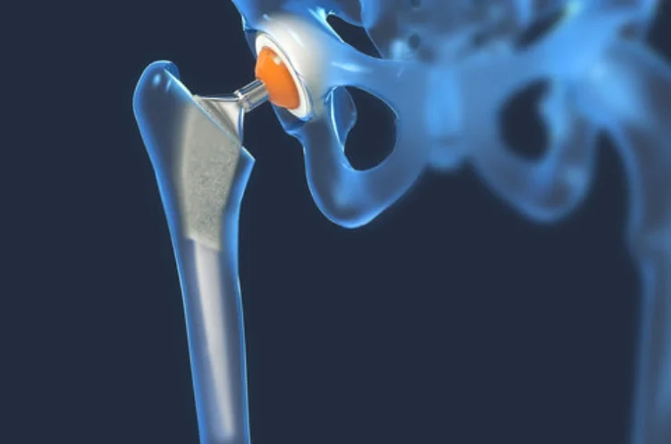 Total Hip Replacement image